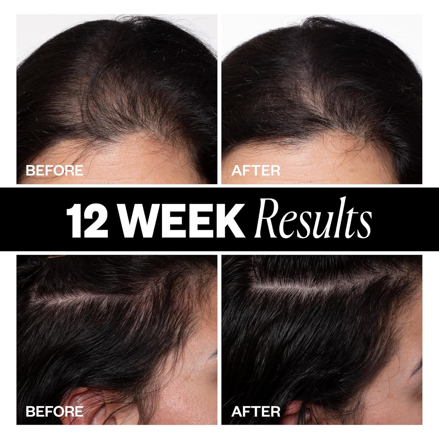 Sponsored - Scalp Treatment for Hair Growth – Hair Thickening Serum for Women – Promotes Fuller, Thicker Hair – Scalp Serum for Hair Density and Thinning - 2.1Oz