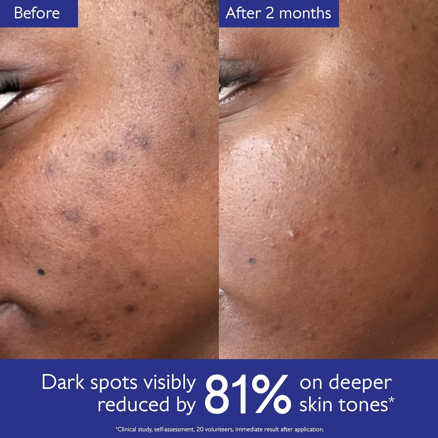 Vinoperfect Brightening Dark Spot Serum Vitamin C Alternative - 62X More Effective than Vitamin C with Viniferine for a Visibly Brighter Even Complexion